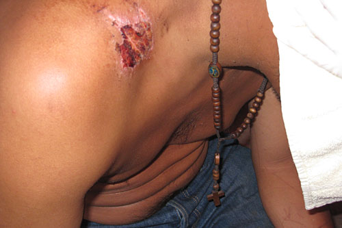 This young man's shoulders were rubbed raw from hauling marijuana across the border.
(David Maxon)